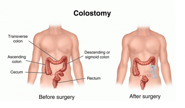 Colostomy – The Australian Council of Stoma Associations Inc