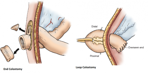 Colostomy – The Australian Council of Stoma Associations Inc